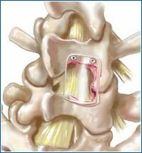 Die bioresorbierbare Folie CardioWrapi(tm) ist zur Verwendung bei kardiovaskulären Folgeoperationen konzipiert.