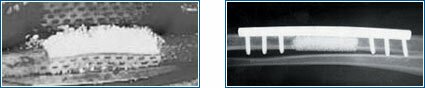 Bone graft material contained in bioresorbable mesh for controlled bone regrowth.