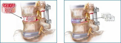 Bioresorbable implants are used in conjunction with rigid fixation in specific spine applications.